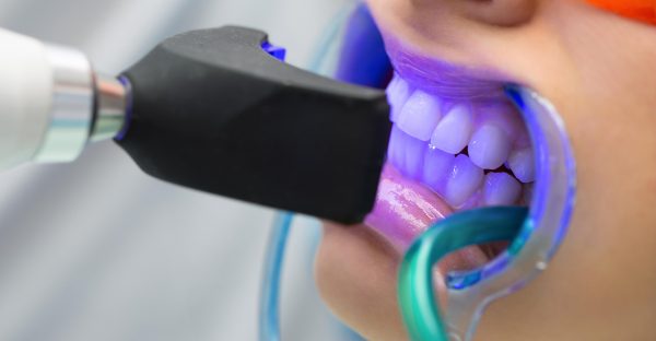 Клиническое отбеливание зубов
