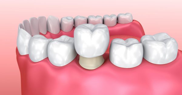 Коронки на жевательные зубы